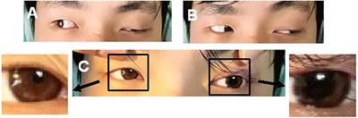 A Case of Recurrent Painful Ophthalmoplegic Neuropathy